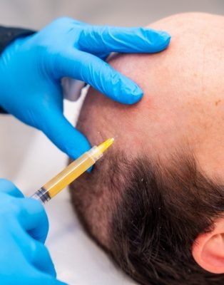 Medicina Capilar 3 Tratamientos de medicina estética capilar en Huelva_3